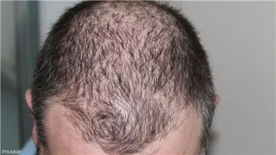 اكتشاف واعد لعلاج الصلع بالسكر الطبيعي